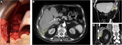 Lost gallstones during laparoscopic cholecystectomy as a common but underestimated complication—case report and review of the literature